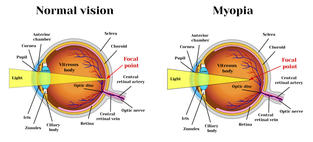 How High Can Myopia Go 1
