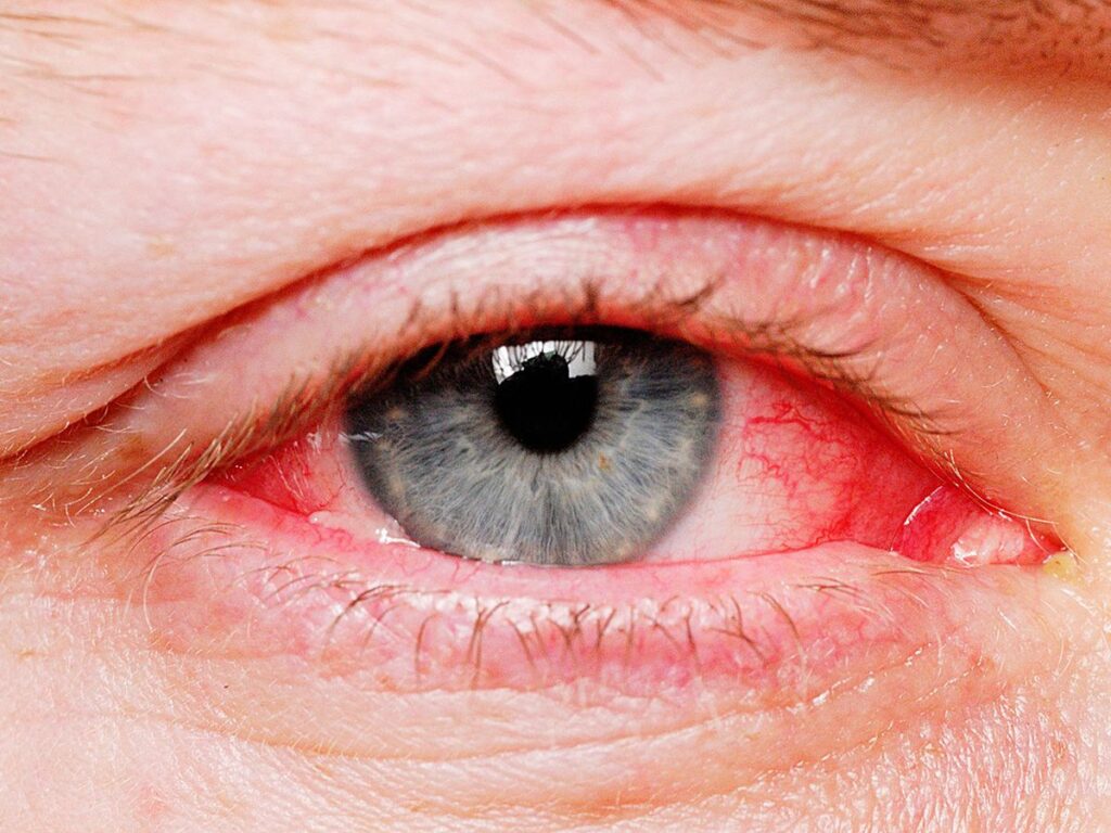 Bloodshot Eyes Symptoms 1