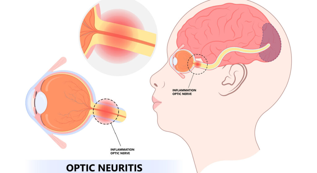 Optic Neuritis Causes 1
